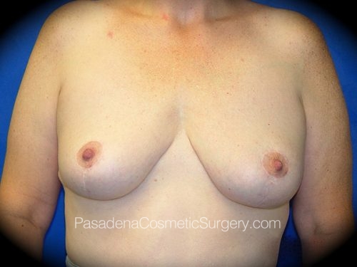 Breast Lift Patient 02 After
