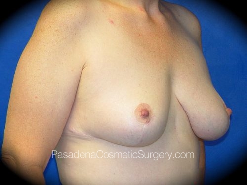 Breast Lift Patient 02 After - 2