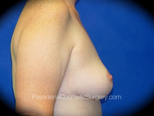 Breast Lift Patient 02 After - 3