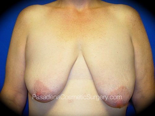 Breast Lift Patient 02 Before