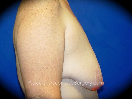 Breast Lift Patient 02 Before - 3