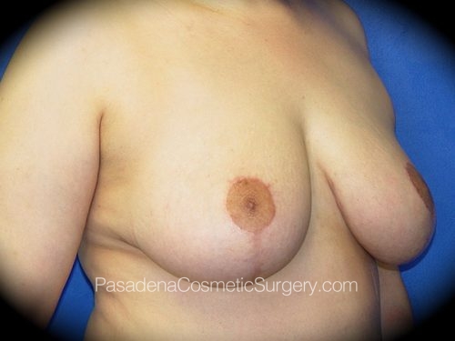 Breast Lift Patient 03 After - 2