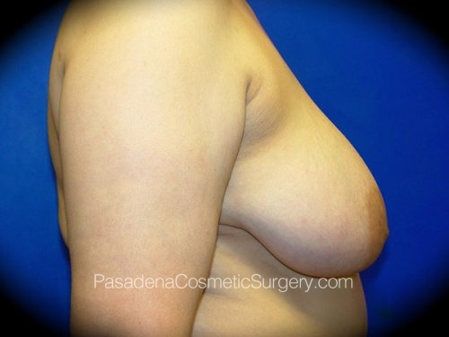 Breast Lift Patient 03 Before - 3