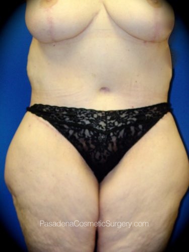 Dr. Martin O'Toole | Tummy Tuck Before & After