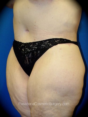 Tummy Tuck Patient 02 After - 2