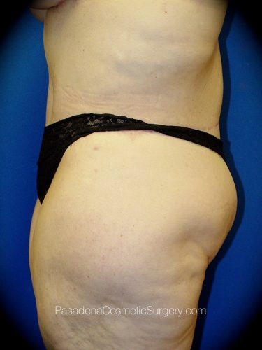 Body Lift Patient 01 After - 3