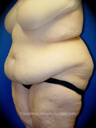 Tummy Tuck Patient 02 Before - 2