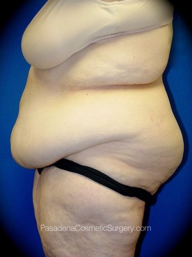 Tummy Tuck Patient 02 Before - 3