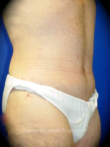 Tummy Tuck Patient 03 After