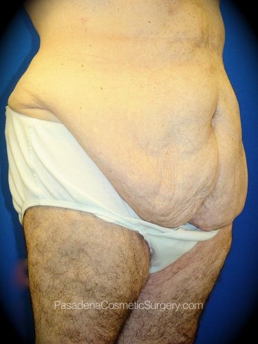 Tummy Tuck Patient 03 Before