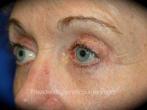 Eyelid Surgery Patient 07 After - 2