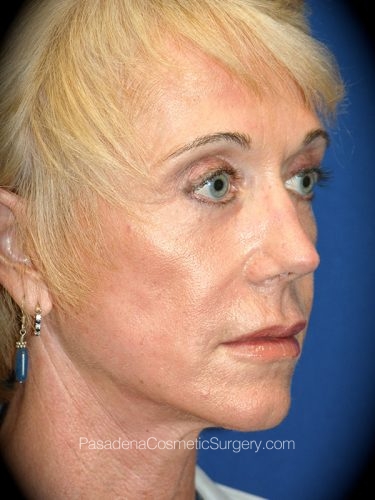 Laser Skin Resurfacing Patient 01 After - 2