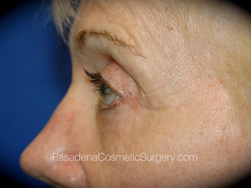 Eyelid Surgery Patient 07 After - 3