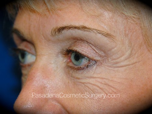 Eyelid Surgery Patient 07 Before - 2