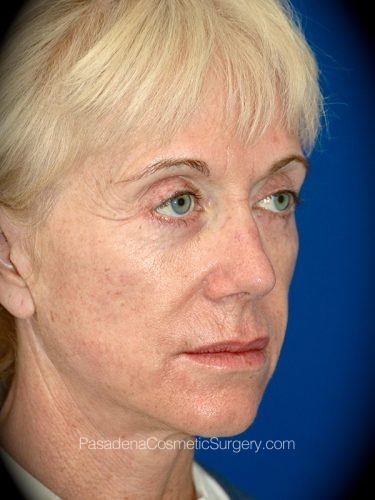 Laser Skin Resurfacing Patient 01 Before - 2
