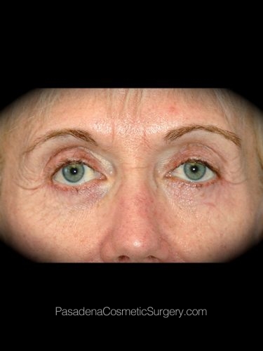 Laser Skin Resurfacing Patient 01 Before - 3