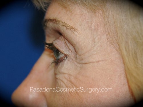 Eyelid Surgery Patient 07 Before - 3