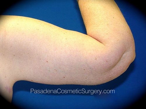 Arm Lift Patient 05 After - 2