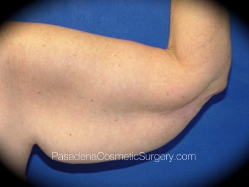 Arm Lift Patient 05 Before - 2