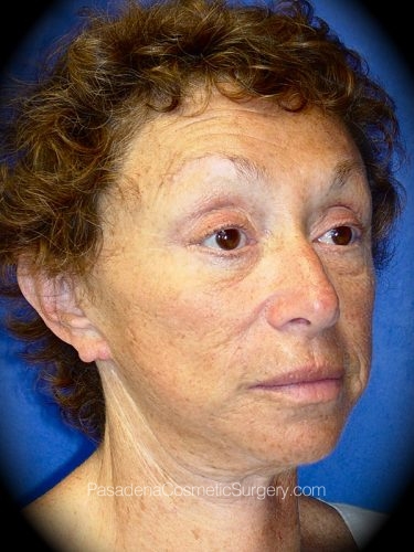 Facelift Patient 04 After - 2
