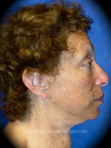 Facelift Patient 04 After - 3