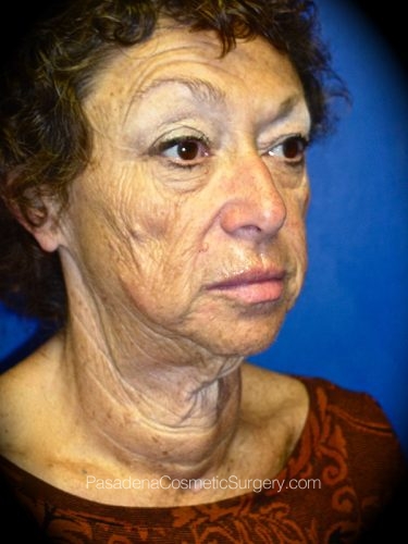 Facelift Patient 04 Before - 2