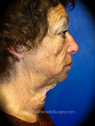 Facelift Patient 04 Before - 3