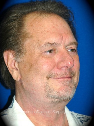 Neck Lift Patient 01 After - 2