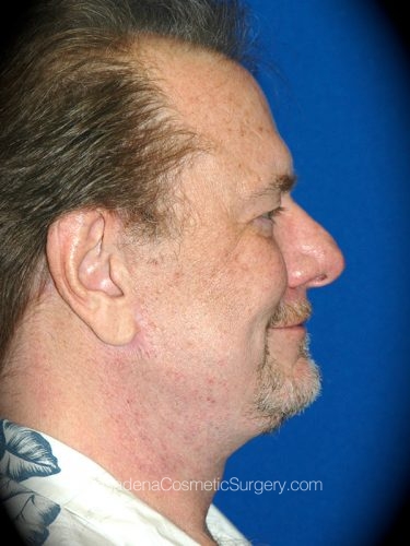 Neck Lift Patient 01 After - 3