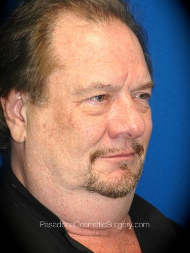 Neck Lift Patient 01 Before - 2