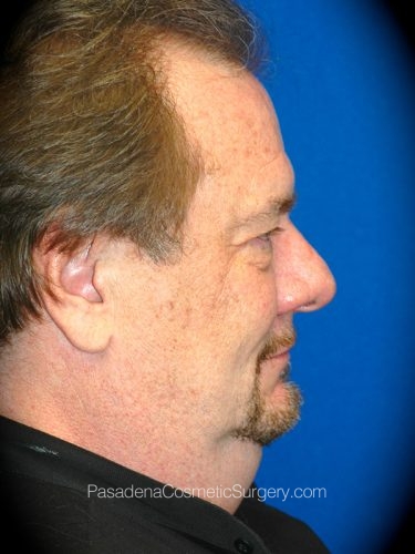 Neck Lift Patient 01 Before - 3