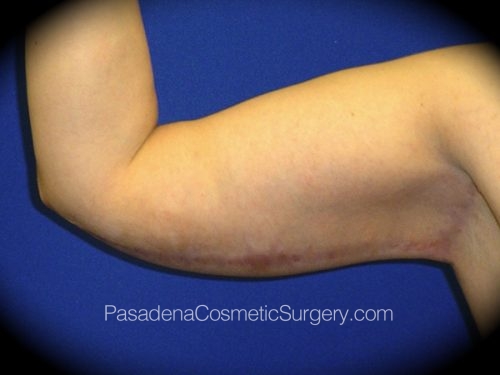 Arm Lift Patient 02 After