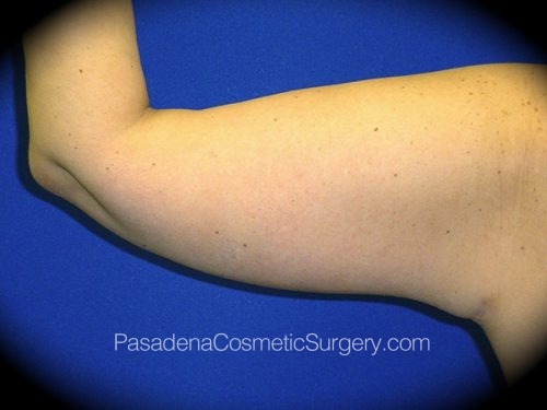 Arm Lift Patient 02 After - 2