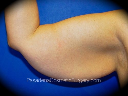 Arm Lift Patient 02 Before