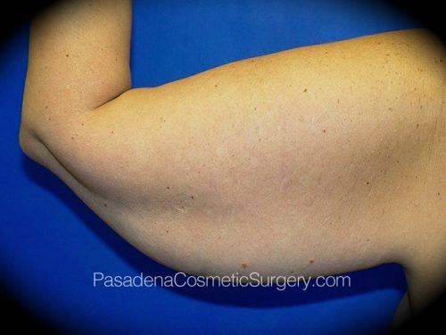 Arm Lift Patient 02 Before - 2