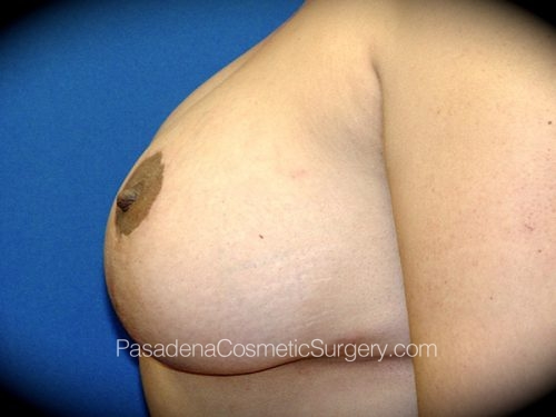 Breast Augmentation with Mastopexy Patient 02 After - 3