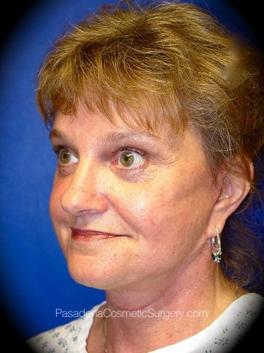 Facelift Patient 05 After - 2