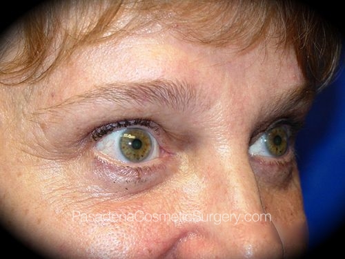 Brow Lift Patient 02 After - 2