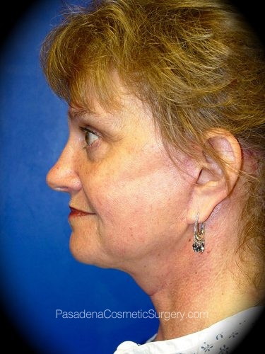 Facelift Patient 05 After - 3