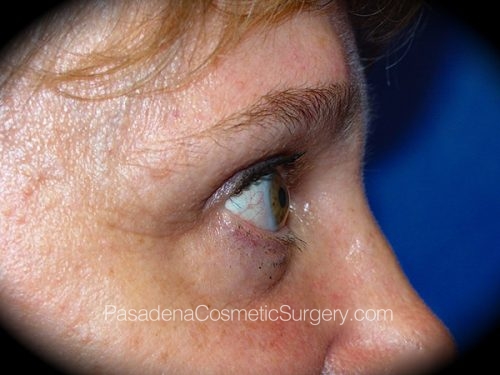 Brow Lift Patient 02 After - 3