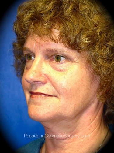 Facelift Patient 05 Before - 2