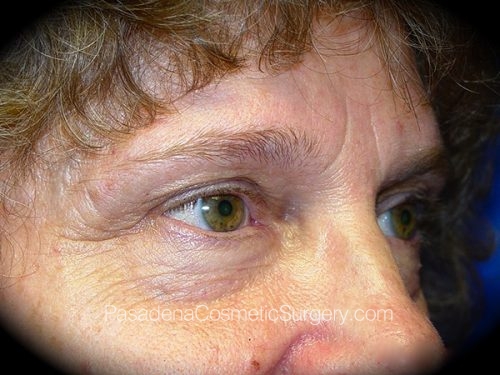 Brow Lift Patient 02 Before - 2