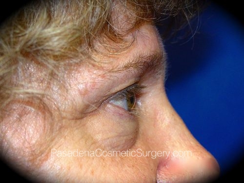 Brow Lift Patient 02 Before - 3