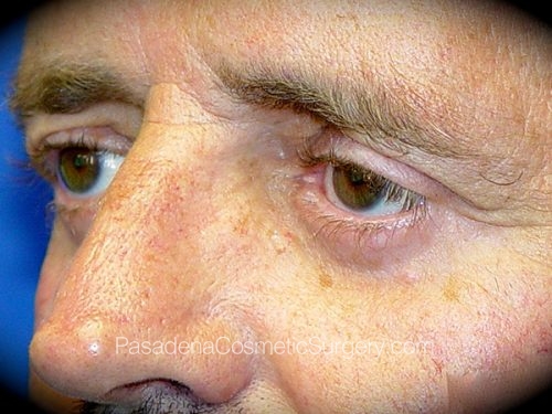 Eyelid Surgery Patient 03 After - 2