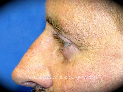 Eyelid Surgery Patient 03 After - 3