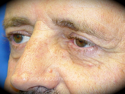 Eyelid Surgery Patient 03 Before - 2