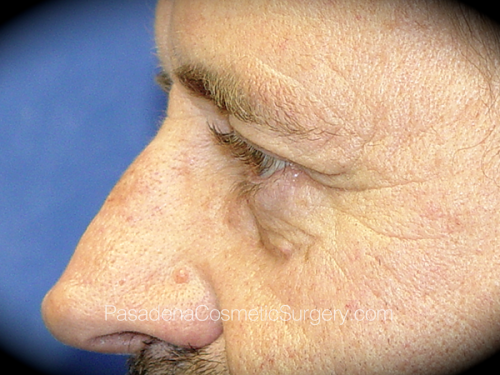 Eyelid Surgery Patient 03 Before - 3