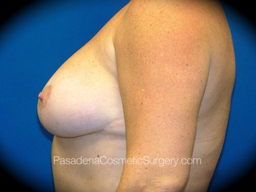 Breast Reduction Patient 03 After - 3
