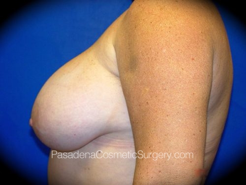 Breast Reduction Patient 03 Before - 3