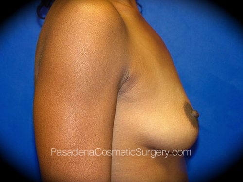 Breast Augmentation Patient 03 Before